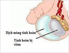 Ảnh Viêm tinh hoàn - 6