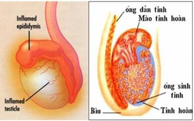 Cùng tìm hiểu bệnh viêm mào tinh hoàn nam giới