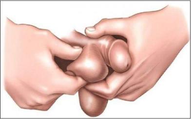 Vì sao tinh hoàn nổi hạch – Thông tin chớ bỏ lỡ