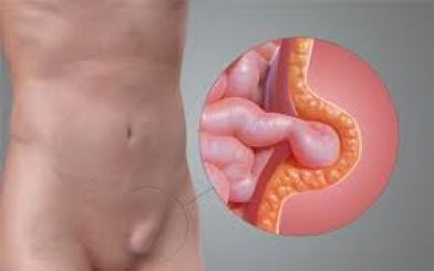 Nổi hạch tinh hoàn là bị gì?