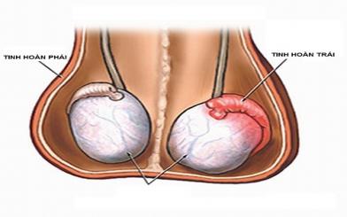Sưng tinh hoàn – Hiện tượng chớ nên coi thường