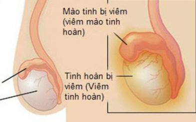Nhận biết sớm các triệu chứng viêm mào tinh hoàn phải