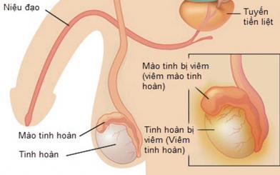 Đau mào tinh hoàn