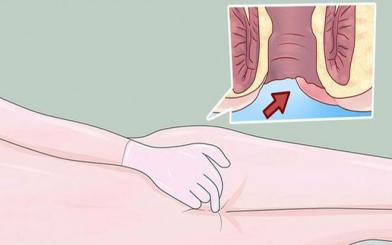 Cảnh giác 4 nguyên nhân xuất hiện cục cứng ở hậu môn