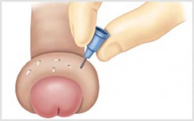 Sưng bao quy đầu và những hệ lụy của bệnh