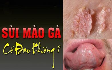 Bệnh sùi mào gà có đau không và chữa được không?