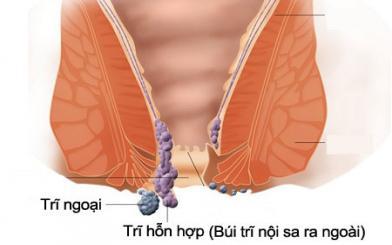 Búi trĩ là gì, nguyên nhân và cách điều trị hiệu quả