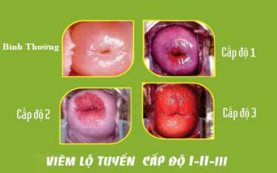 Dấu hiệu viêm lộ tuyến cổ tử cung bạn nên biết