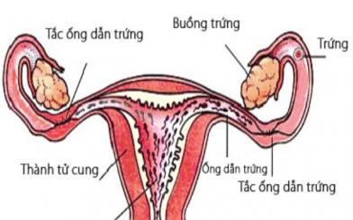 Dấu hiệu tắc vòi trứng chị em không nên chủ quan