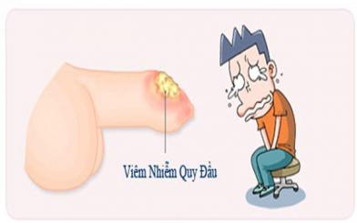 Bệnh viêm bao quy đầu có nguy hiểm không