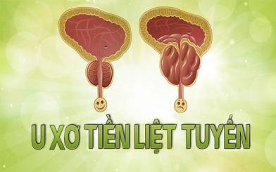 Bệnh u xơ tiền liệt tuyến là gì