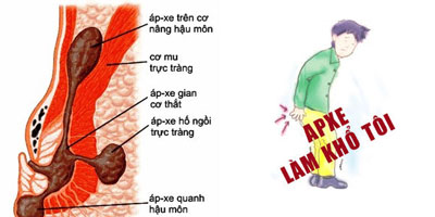 Áp xe hậu môn