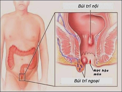 Bệnh nứt kẽ hậu môn