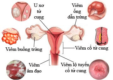 Dấu hiệu của bệnh phụ khoa