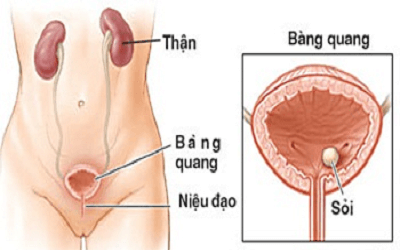 Bệnh viêm bàng quang 