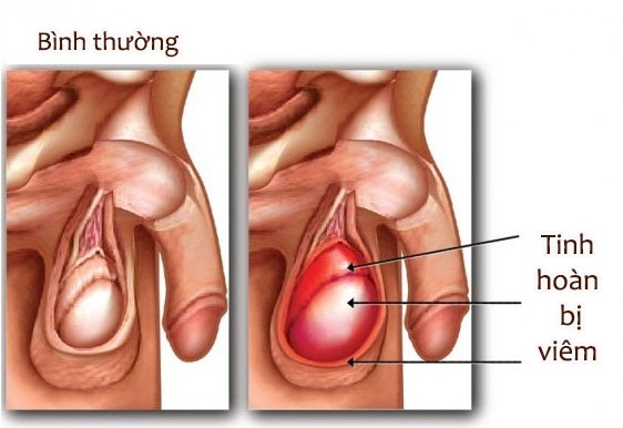 Tinh trùng có màu hồng có thể do bệnh viêm tinh hoàn