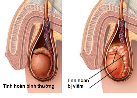 Biểu hiện viêm tinh hoàn