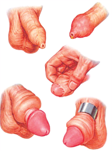 Cách lột bao quy đầu cho trẻ