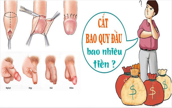 Chi phí cắt bao quy đầu