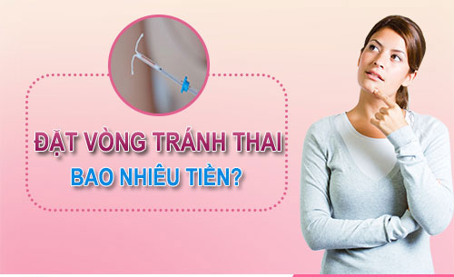 Chi phí đặt vòng tránh thai là bao nhiêu?