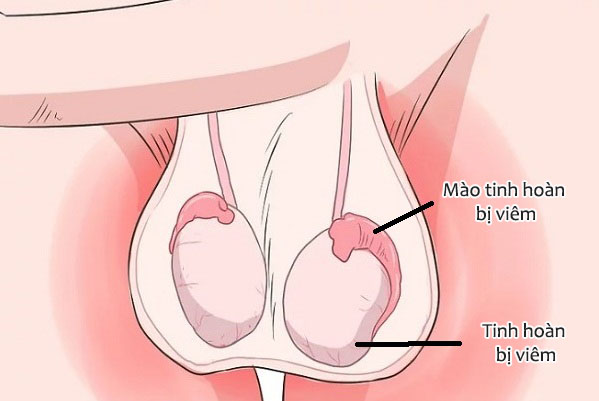 Viêm mào tinh hoàn