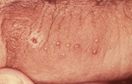 Dấu hiệu của bệnh sùi mào gà ở nam giới