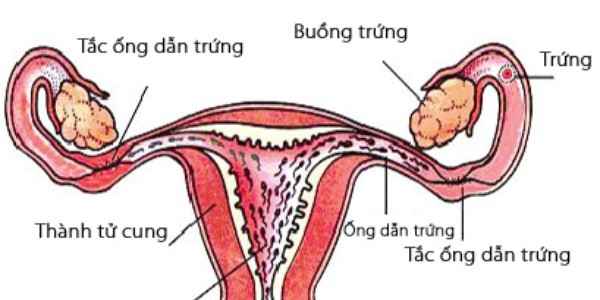 Dấu hiệu tắc vòi trứng