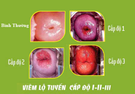 Viêm lộ tuyến cổ tử cung