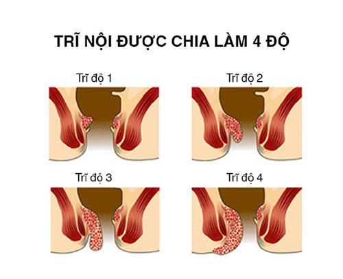 Đi ngoài ra máu do bệnh trĩ