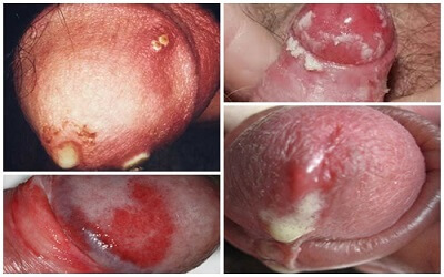 Dương vật chảy mủ do bệnh lậu