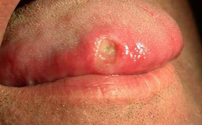 Giang mai lây nhiễm qua đường miệng
