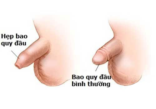 Hẹp bao quy đầu là gì