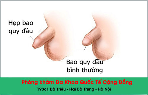 Hẹp bao quy đầu