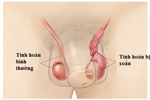 Xoắn tinh hoàn là nguyên nhân gây đau tinh hoàn trái