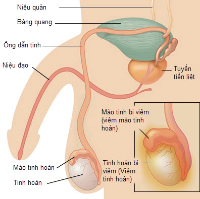 Viêm tinh hoàn và mào tinh hoàn