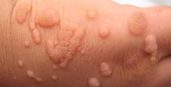 Mụn cóc dương vật có phải bệnh sùi mào gà