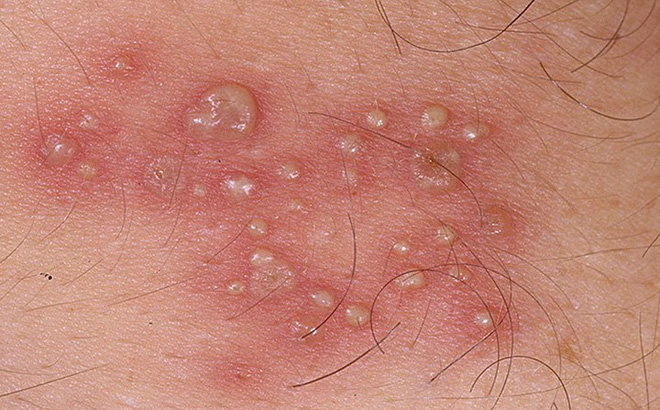 Mụn rộp sinh dục