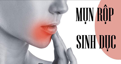 Nguyên nhân của bệnh mụn rộp sinh dục