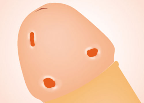 Nổi mụn đỏ ở dương vật 