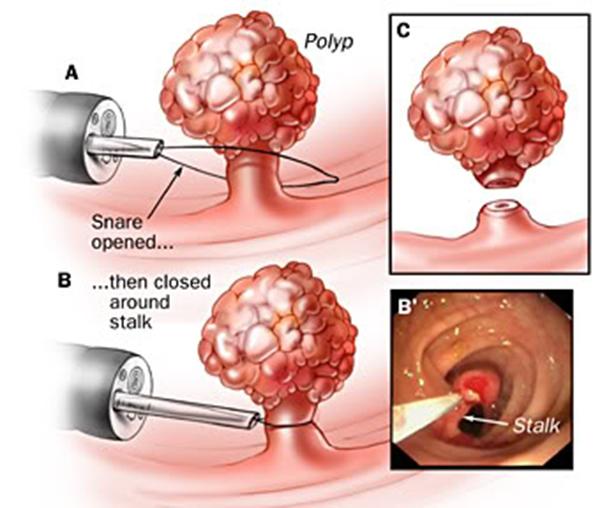 Bệnh polyp trực tràng