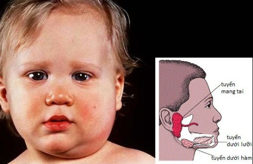 Quai bị gây biến chứng viêm tinh hoàn ở trẻ em
