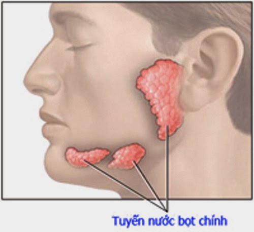 Biến chứng quai bị gây viêm tinh hoàn