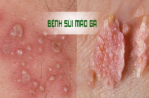 Sùi mào gà có chữa được không?
