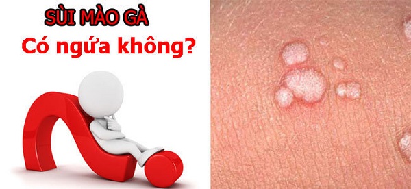 Sùi mào gà có gây ngứa không?