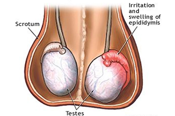 Sưng tinh hoàn là triệu chứng nhận biết bệnh viêm tinh hoàn
