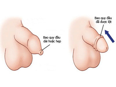 Thế nào là dài bao quy đầu nam giới