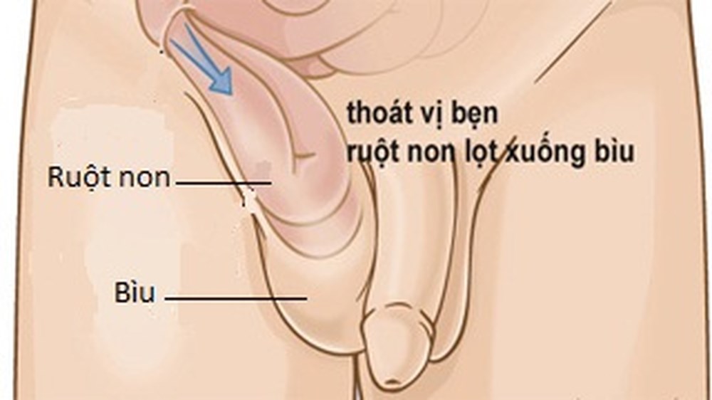 Thoát vị bẹn