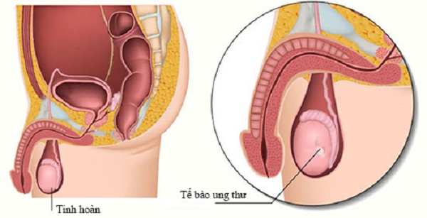 Tinh hoàn thòng gây ra căn bệnh quái ác: Ung thư tinh hoàn