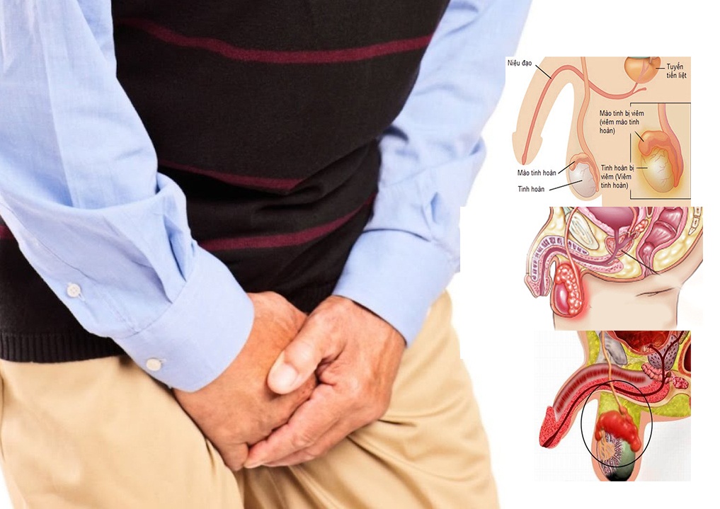 Tổng quan về bệnh viêm tinh hoàn