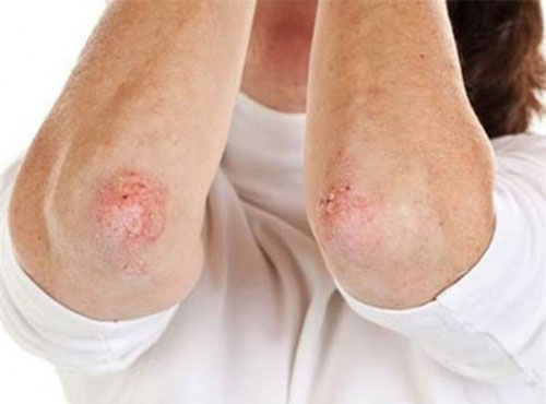 Triệu chứng của bệnh giang mai giai đoạn đầu